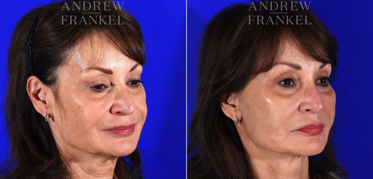 Facelift before and after photos in Beverly Hills, CA, Patient 14988