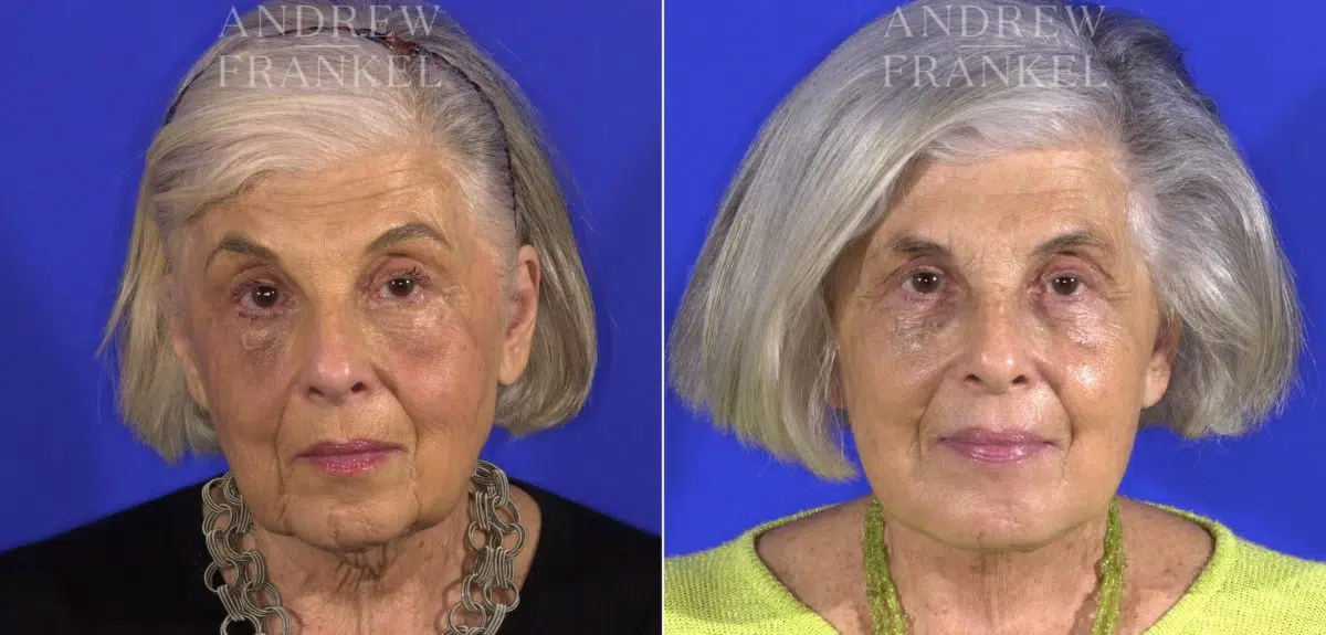 Facelift before and after photos in Beverly Hills, CA, Patient 15006