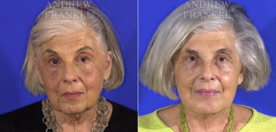 Facelift before and after photos in Beverly Hills, CA, Patient 15006