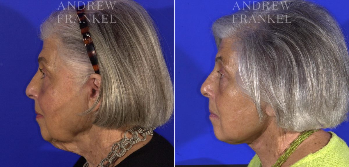 Facelift before and after photos in Beverly Hills, CA, Patient 15006
