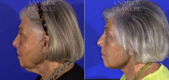 Facelift before and after photos in Beverly Hills, CA, Patient 15006