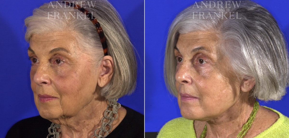 Facelift before and after photos in Beverly Hills, CA, Patient 15006