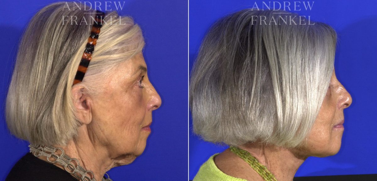 Facelift before and after photos in Beverly Hills, CA, Patient 15006
