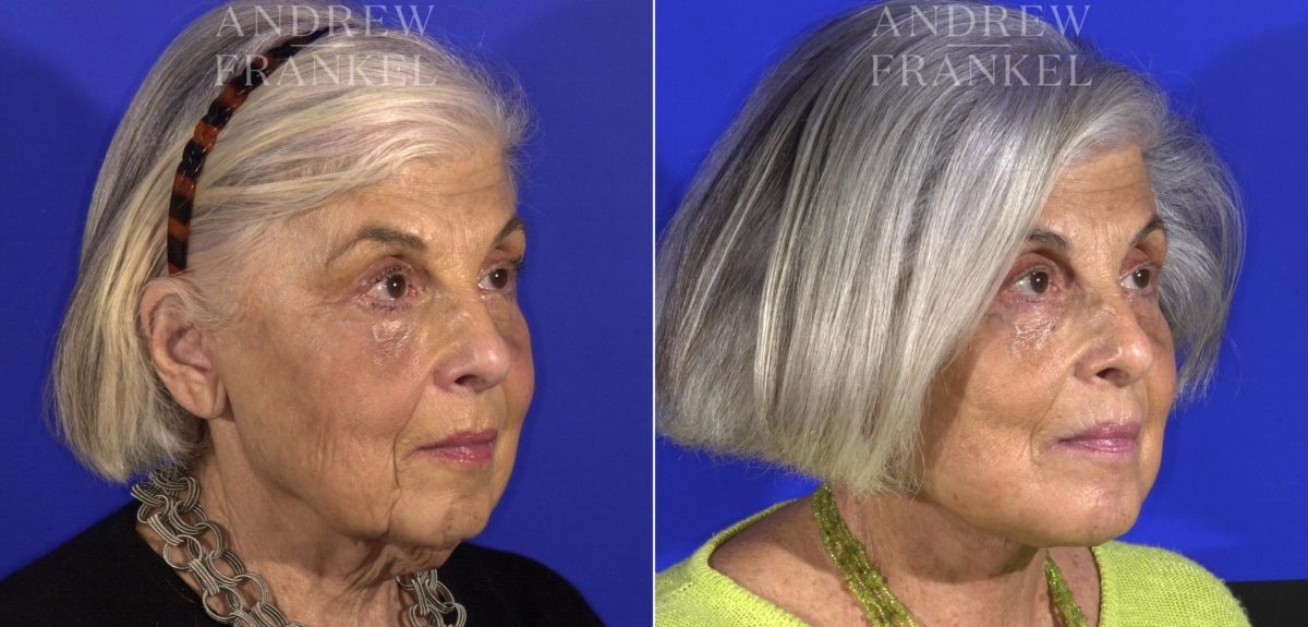 Facelift before and after photos in Beverly Hills, CA, Patient 15006