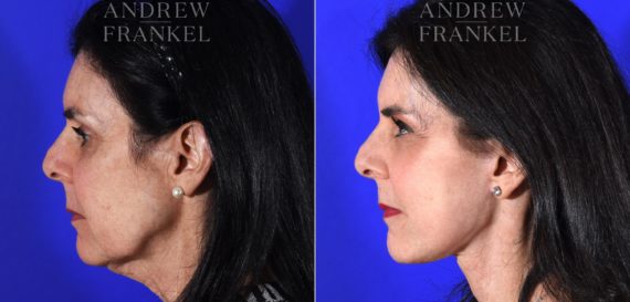 Facelift before and after photos in Beverly Hills, CA, Patient 11380