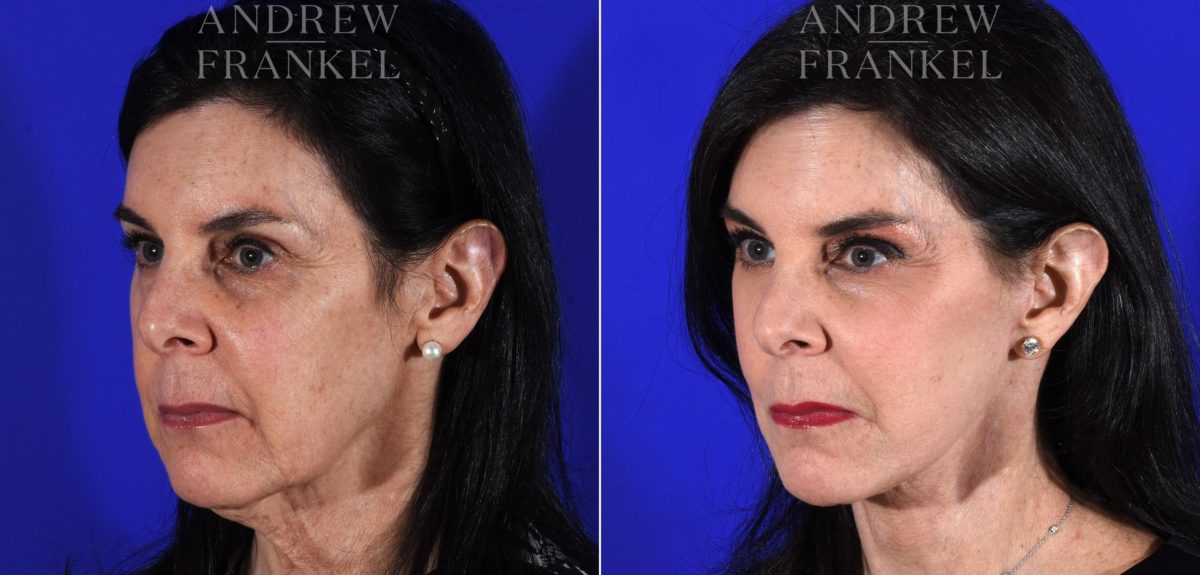 Facelift before and after photos in Beverly Hills, CA, Patient 11380