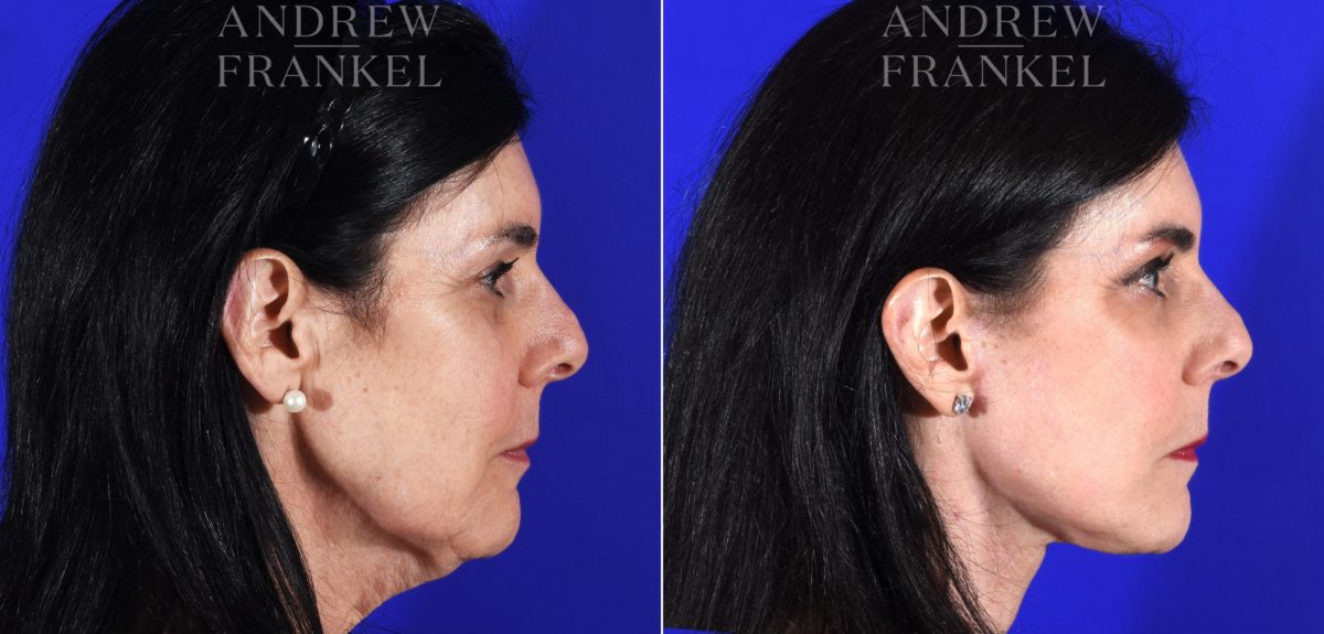 Facelift before and after photos in Beverly Hills, CA, Patient 11380