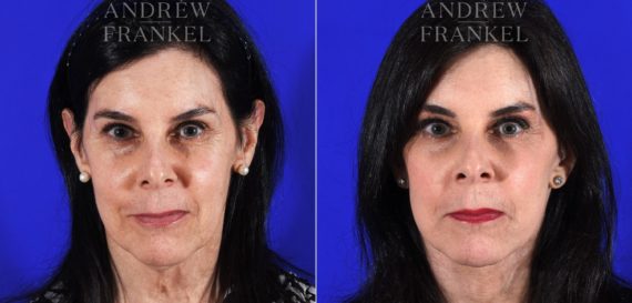 Facelift before and after photos in Beverly Hills, CA, Patient 11380