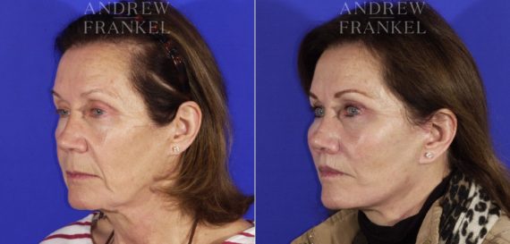 Lip Lift before and after photos in Beverly Hills, CA, Patient 11451