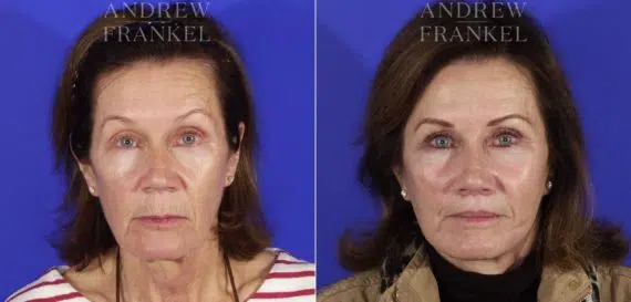 Lip Lift before and after photos in Beverly Hills, CA, Patient 11451