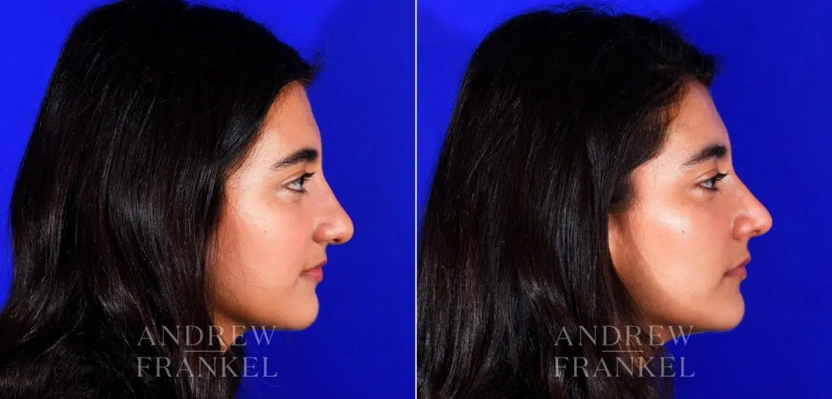 Rhinoplasty before and after photos in Beverly Hills, CA, Patient 12713