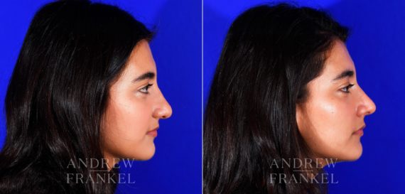 Rhinoplasty before and after photos in Beverly Hills, CA, Patient 12713