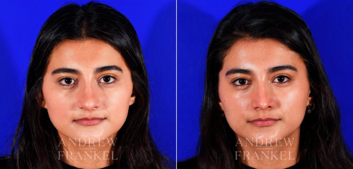 Rhinoplasty before and after photos in Beverly Hills, CA, Patient 12713