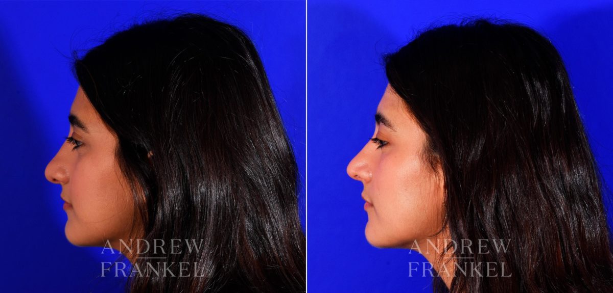 Rhinoplasty before and after photos in Beverly Hills, CA, Patient 12713