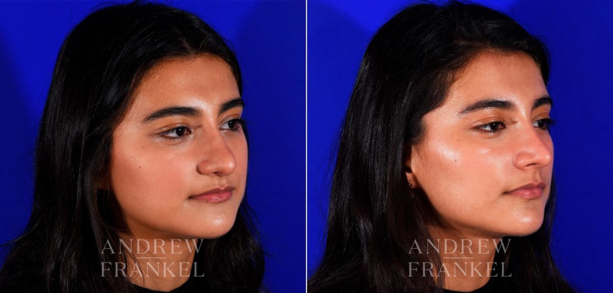 Rhinoplasty before and after photos in Beverly Hills, CA, Patient 12713