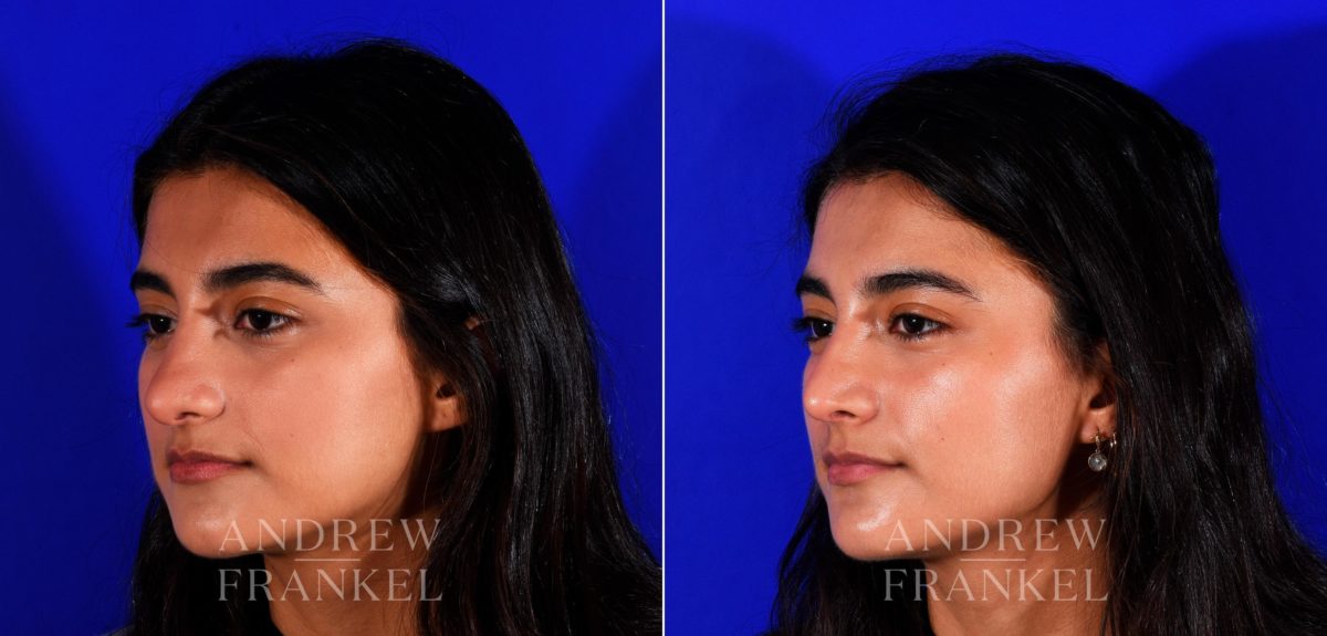 Rhinoplasty before and after photos in Beverly Hills, CA, Patient 12713