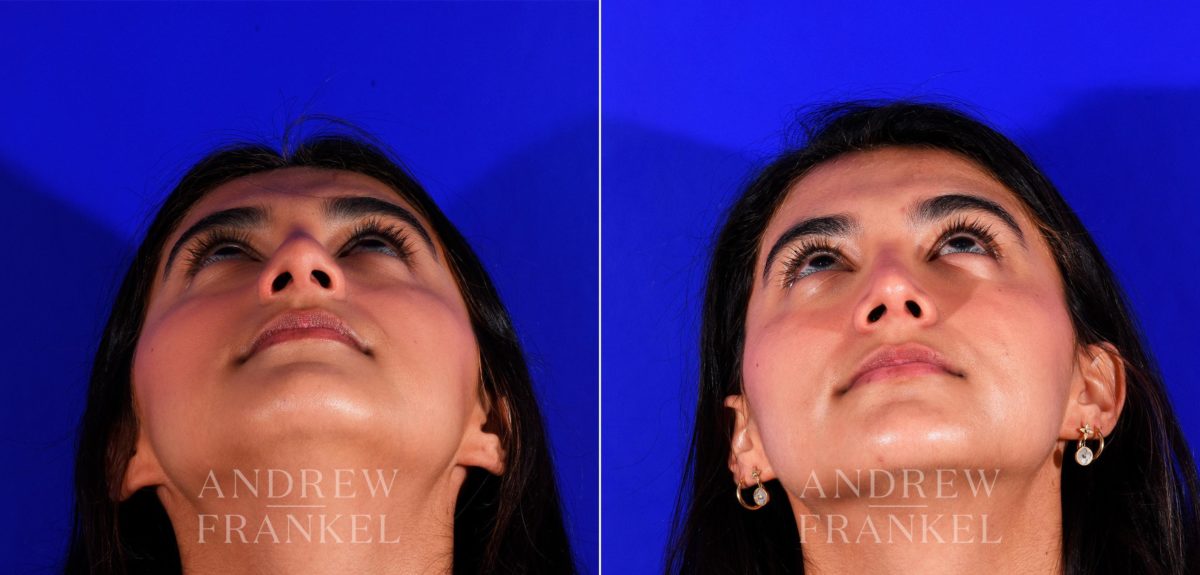 Rhinoplasty before and after photos in Beverly Hills, CA, Patient 12713