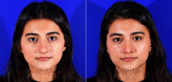 Rhinoplasty before and after photos in Beverly Hills, CA, Patient 12713