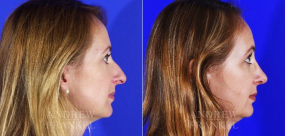 Rhinoplasty before and after photos in Beverly Hills, CA, Patient 12778