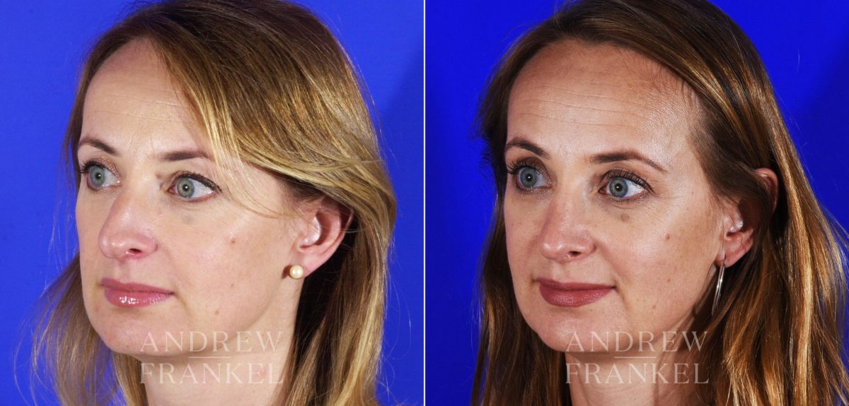 Rhinoplasty before and after photos in Beverly Hills, CA, Patient 12778