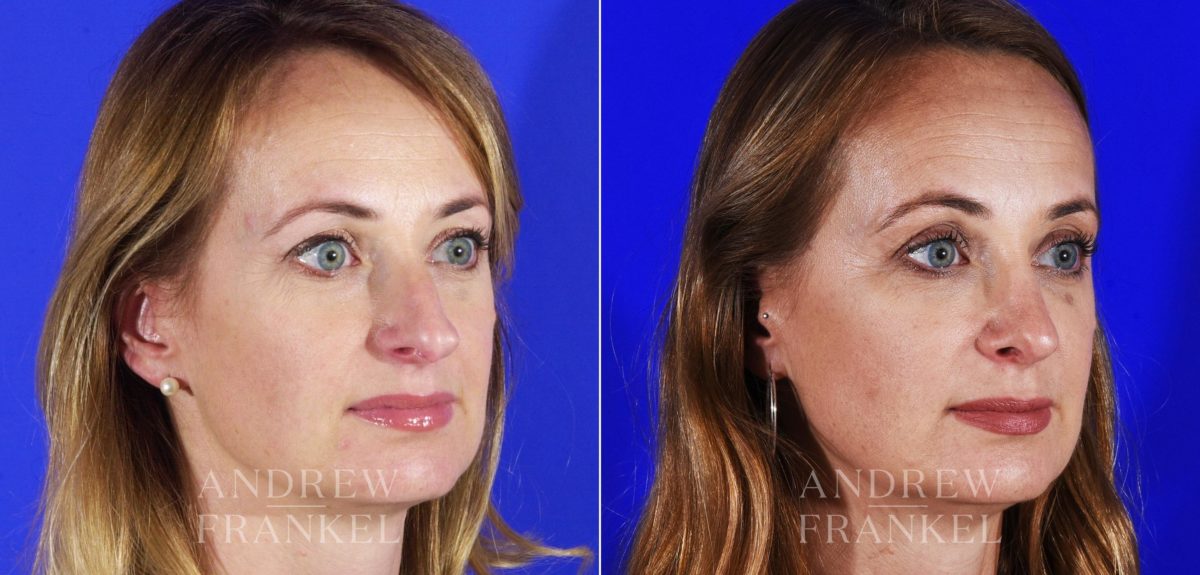 Rhinoplasty before and after photos in Beverly Hills, CA, Patient 12778