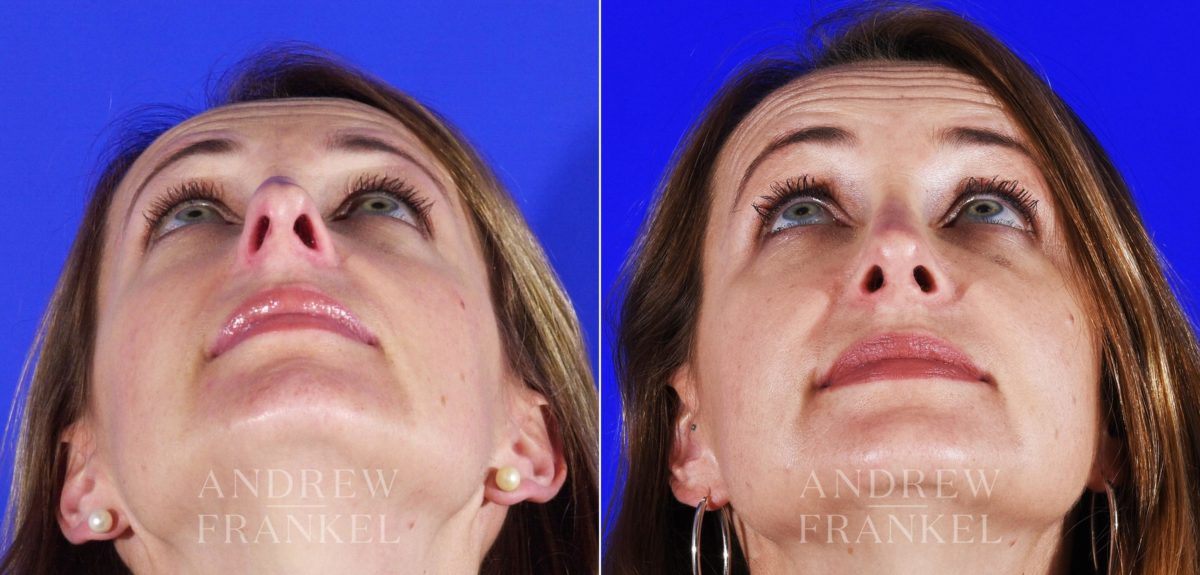 Rhinoplasty before and after photos in Beverly Hills, CA, Patient 12778