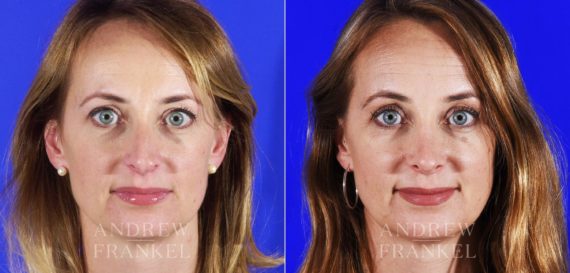 Rhinoplasty before and after photos in Beverly Hills, CA, Patient 12778