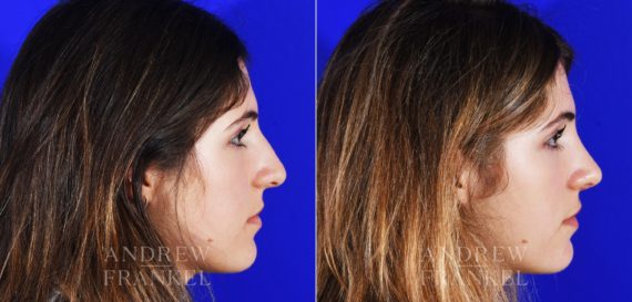 Rhinoplasty before and after photos in Beverly Hills, CA, Patient 12853