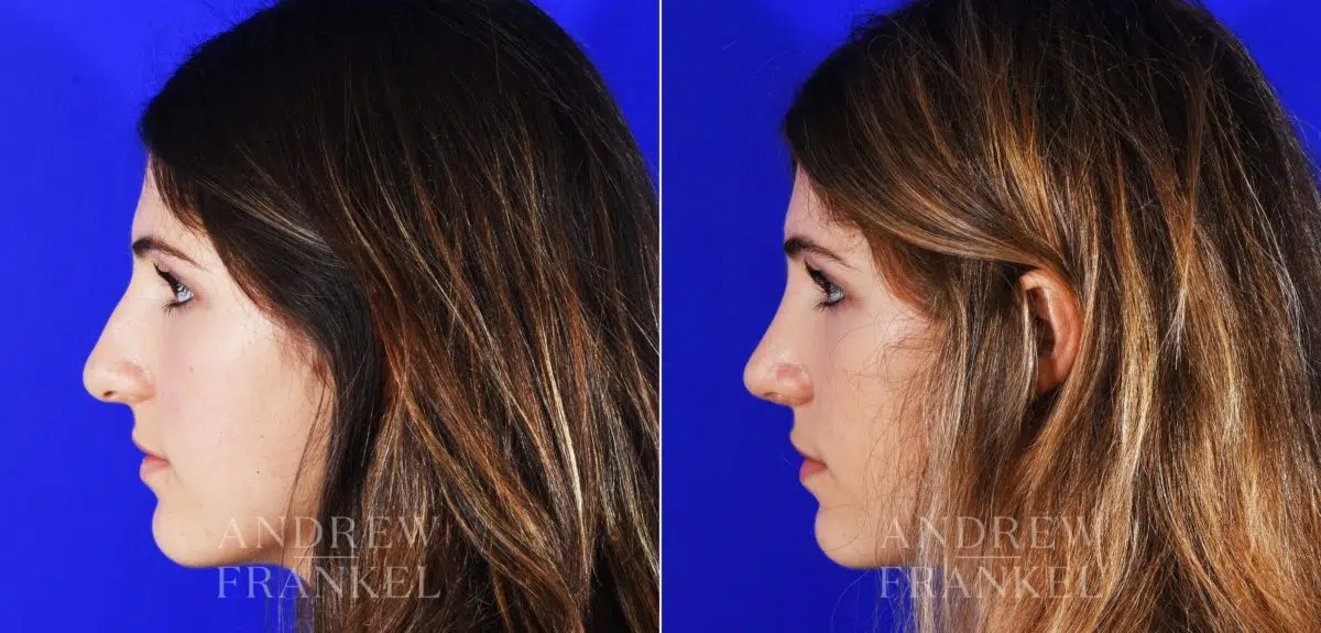 Rhinoplasty before and after photos in Beverly Hills, CA, Patient 12853