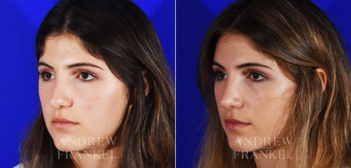 Rhinoplasty before and after photos in Beverly Hills, CA, Patient 12853