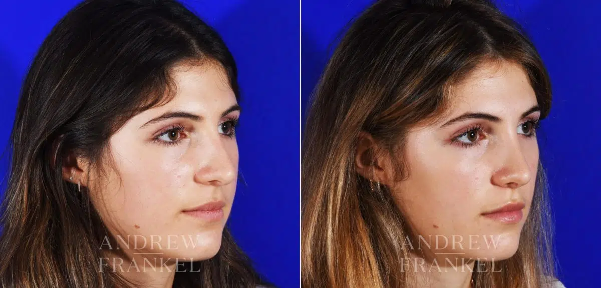 Rhinoplasty before and after photos in Beverly Hills, CA, Patient 12853