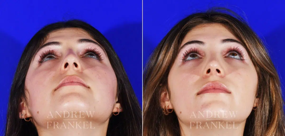 Rhinoplasty before and after photos in Beverly Hills, CA, Patient 12853