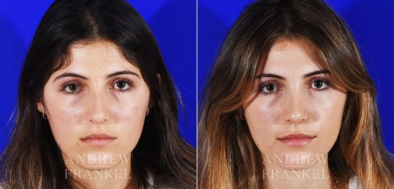 Rhinoplasty before and after photos in Beverly Hills, CA, Patient 12853