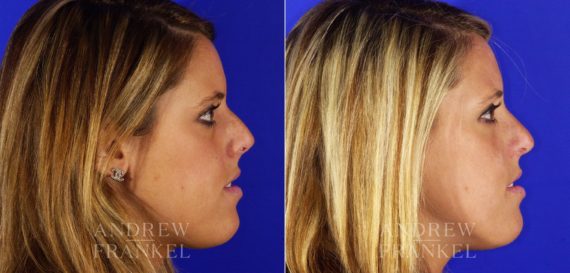 Rhinoplasty before and after photos in Beverly Hills, CA, Patient 12980