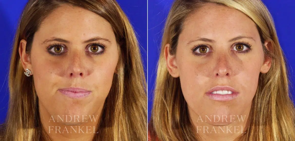 Rhinoplasty before and after photos in Beverly Hills, CA, Patient 12980