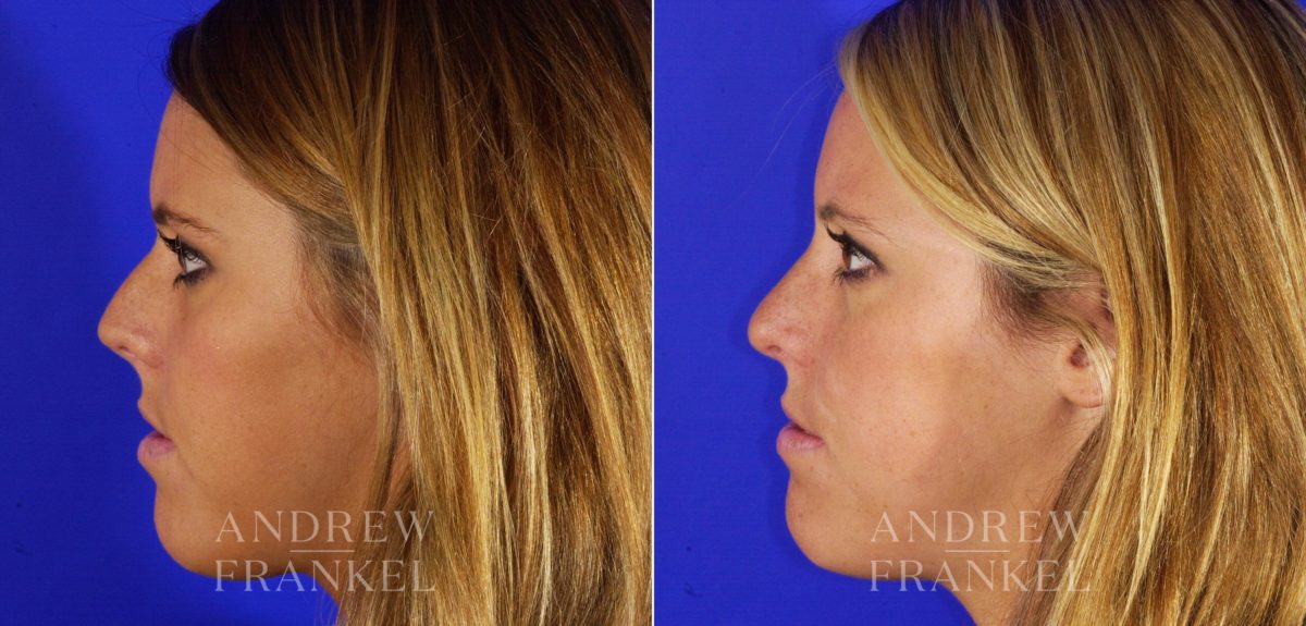 Rhinoplasty before and after photos in Beverly Hills, CA, Patient 12980