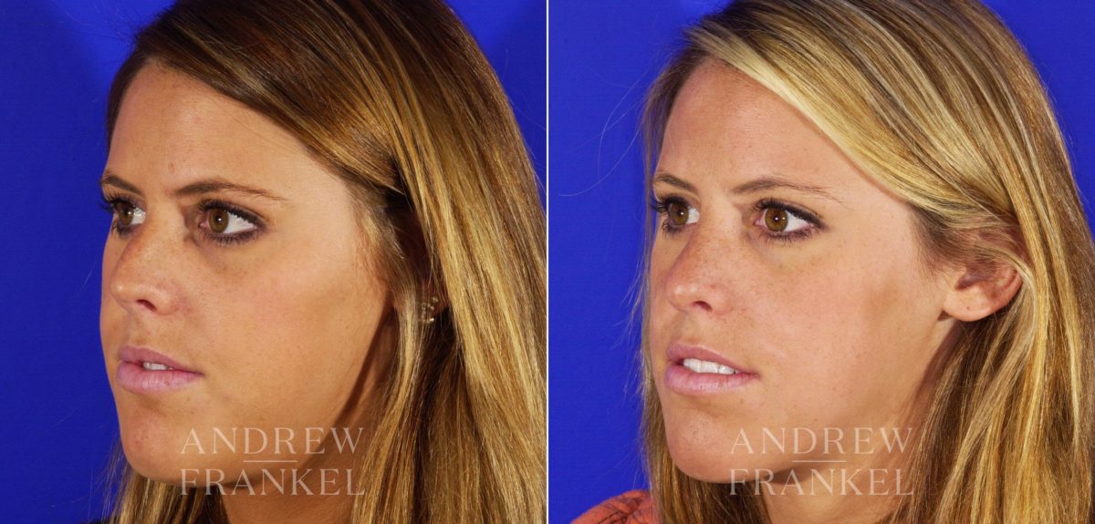Rhinoplasty before and after photos in Beverly Hills, CA, Patient 12980