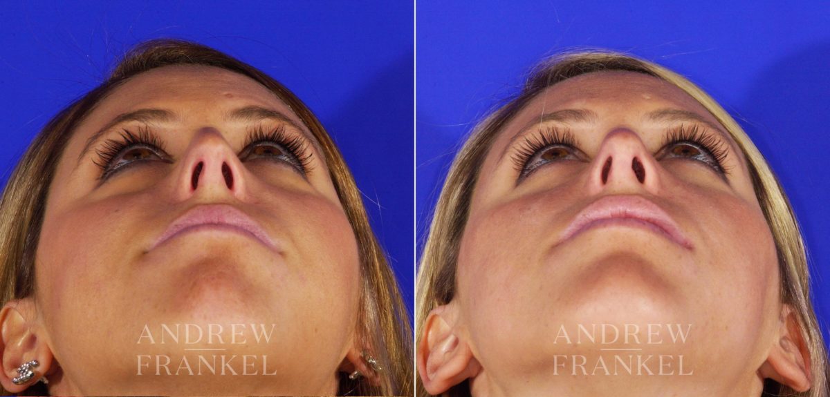 Rhinoplasty before and after photos in Beverly Hills, CA, Patient 12980