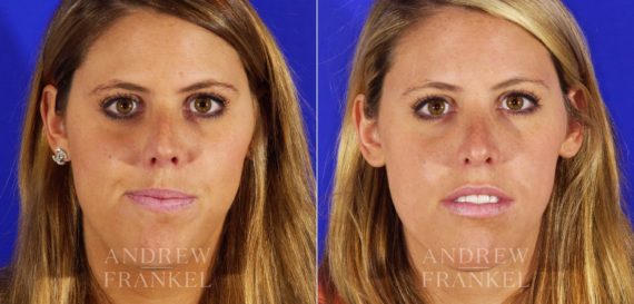 Rhinoplasty before and after photos in Beverly Hills, CA, Patient 12980