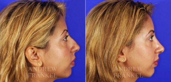 Rhinoplasty before and after photos in Beverly Hills, CA, Patient 13029
