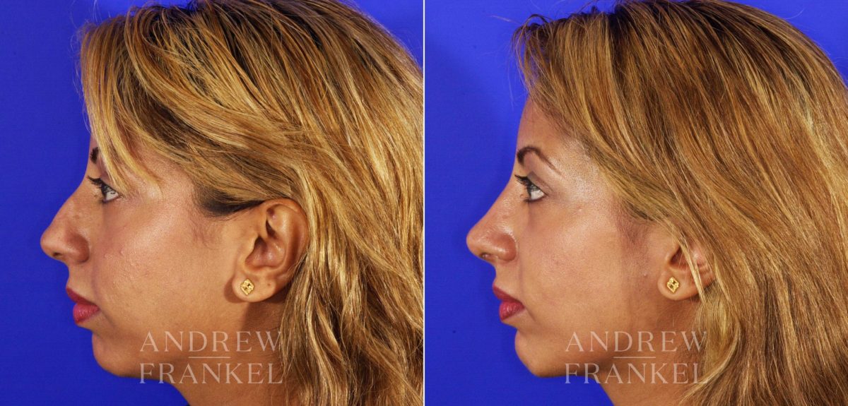 Rhinoplasty before and after photos in Beverly Hills, CA, Patient 13029