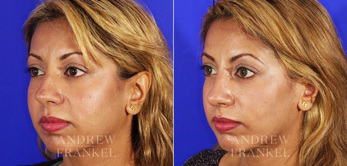 Rhinoplasty before and after photos in Beverly Hills, CA, Patient 13029