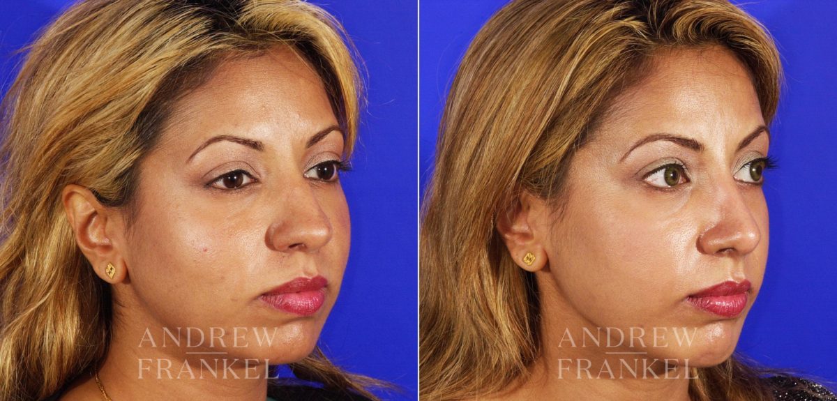 Rhinoplasty before and after photos in Beverly Hills, CA, Patient 13029