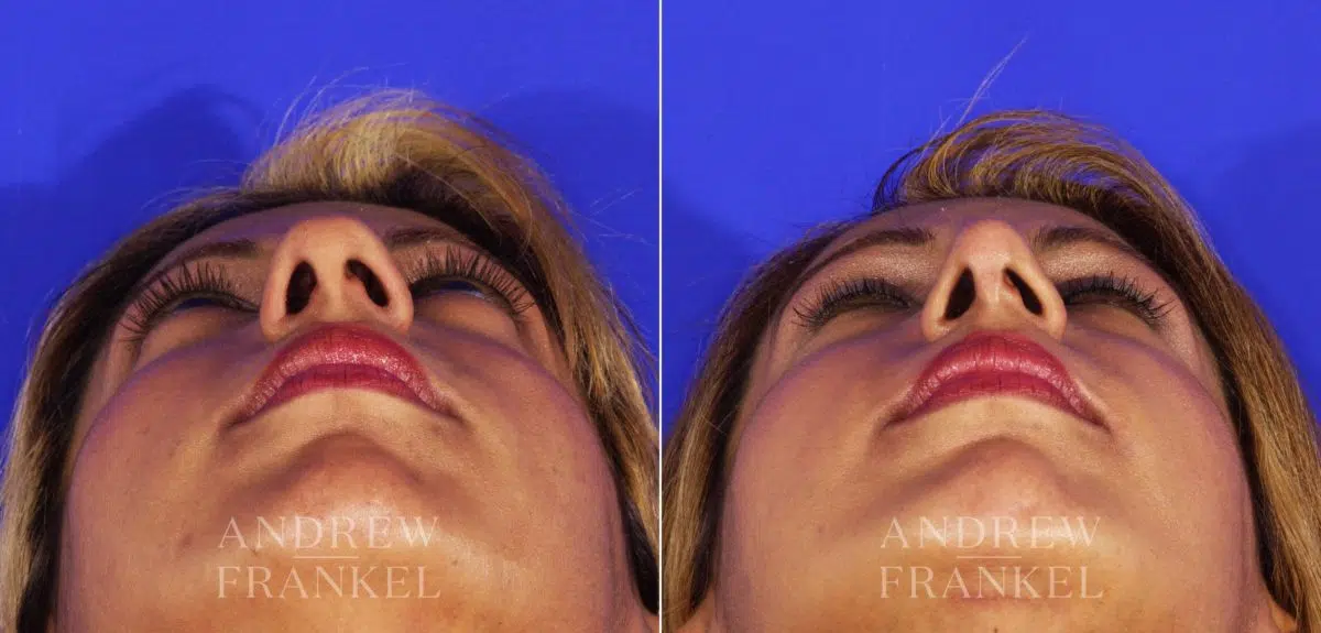 Rhinoplasty before and after photos in Beverly Hills, CA, Patient 13029