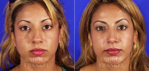 Rhinoplasty before and after photos in Beverly Hills, CA, Patient 13029