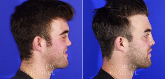 Rhinoplasty before and after photos in Beverly Hills, CA, Patient 13049