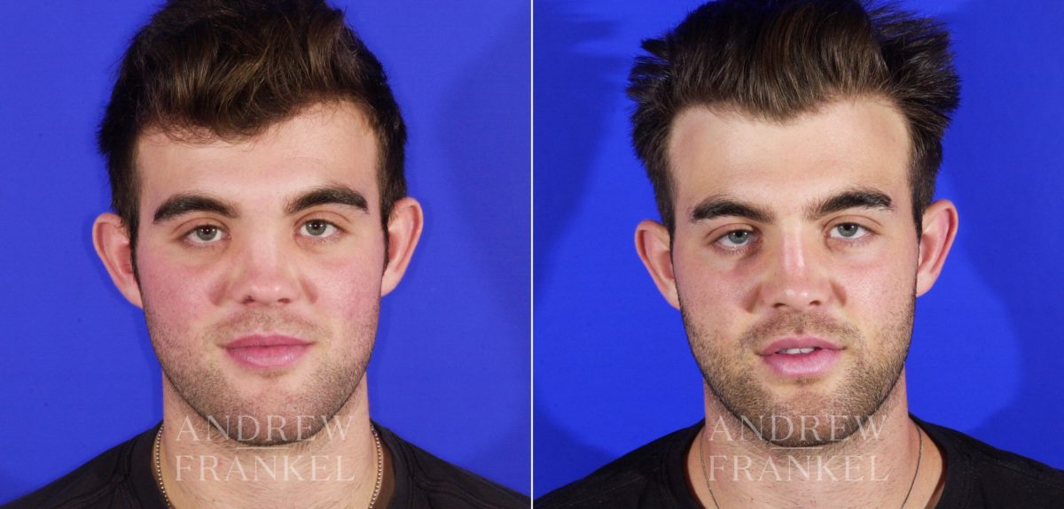 Rhinoplasty before and after photos in Beverly Hills, CA, Patient 13049