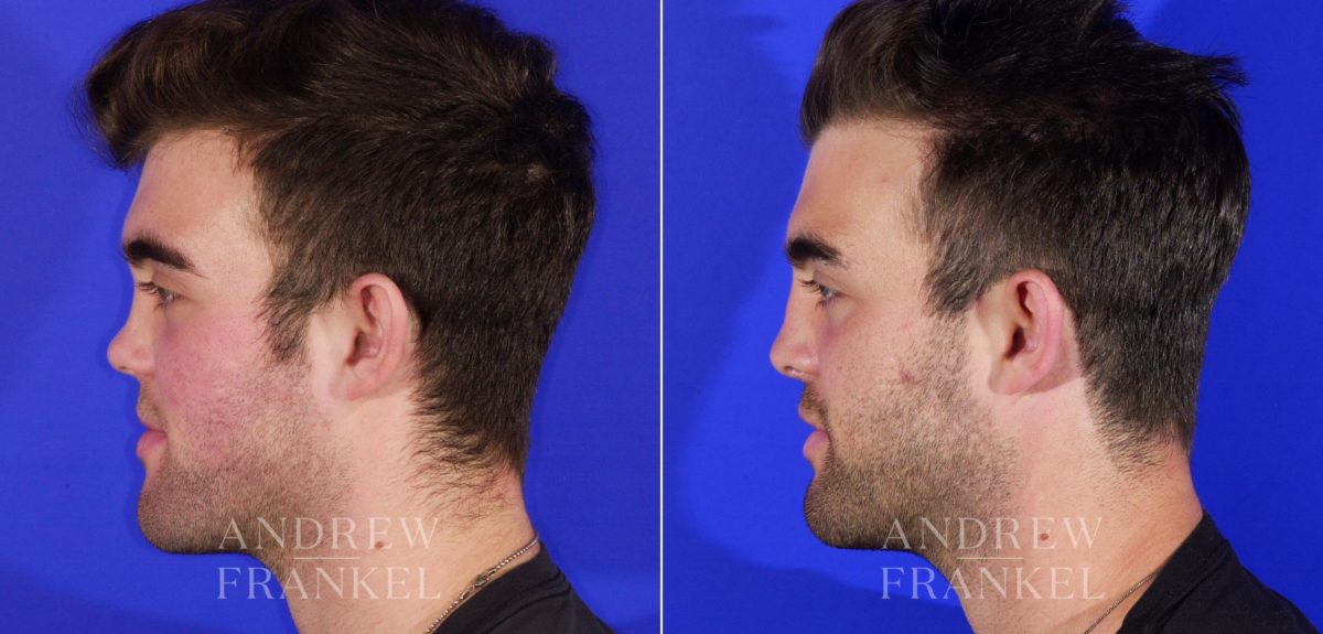 Rhinoplasty before and after photos in Beverly Hills, CA, Patient 13049