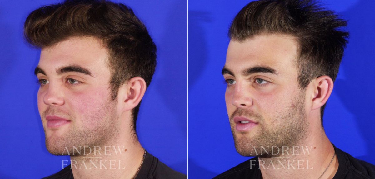 Rhinoplasty before and after photos in Beverly Hills, CA, Patient 13049