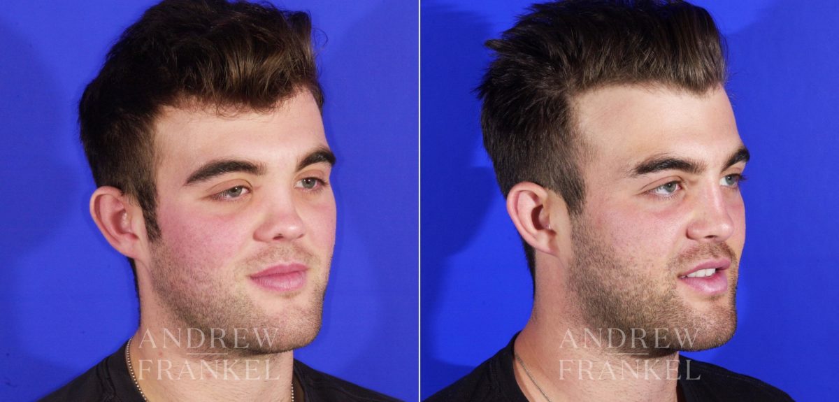 Rhinoplasty before and after photos in Beverly Hills, CA, Patient 13049